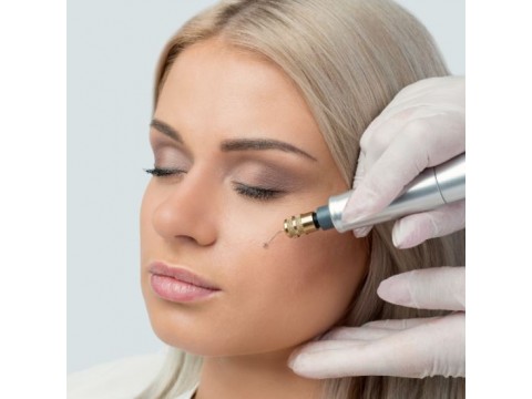 Pykčio/ aplink lūpas raukšlių mažinimo plazma liftingas FIBROBLAST, "OLD TOWN SPA" masažo ir grožio klinikoje Vilniuje